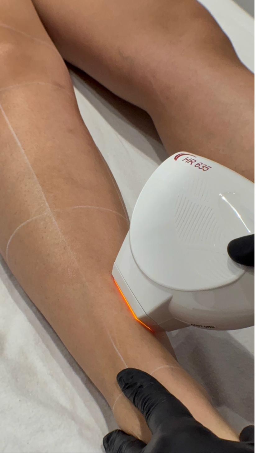 Épilation laser Montréal - Sharplight HR 635